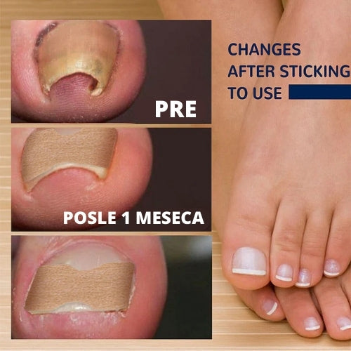 Flasteri za urasle nokte 1+1 GRATIS